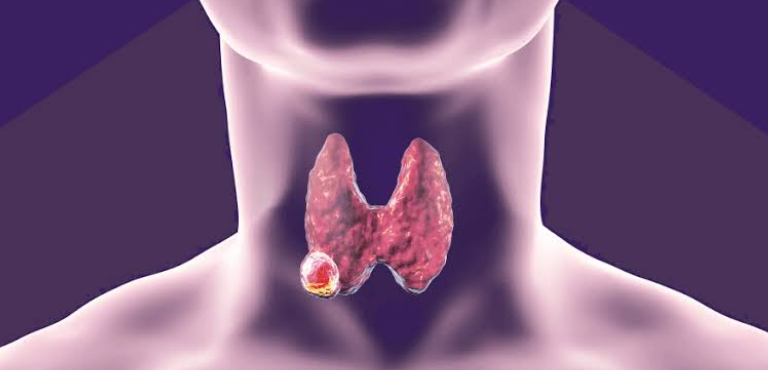 Impact of Pregnancy on the Progression of Papillary Thyroid Microcarcinoma: Is Active Surveillance Still a Safe Strategy?